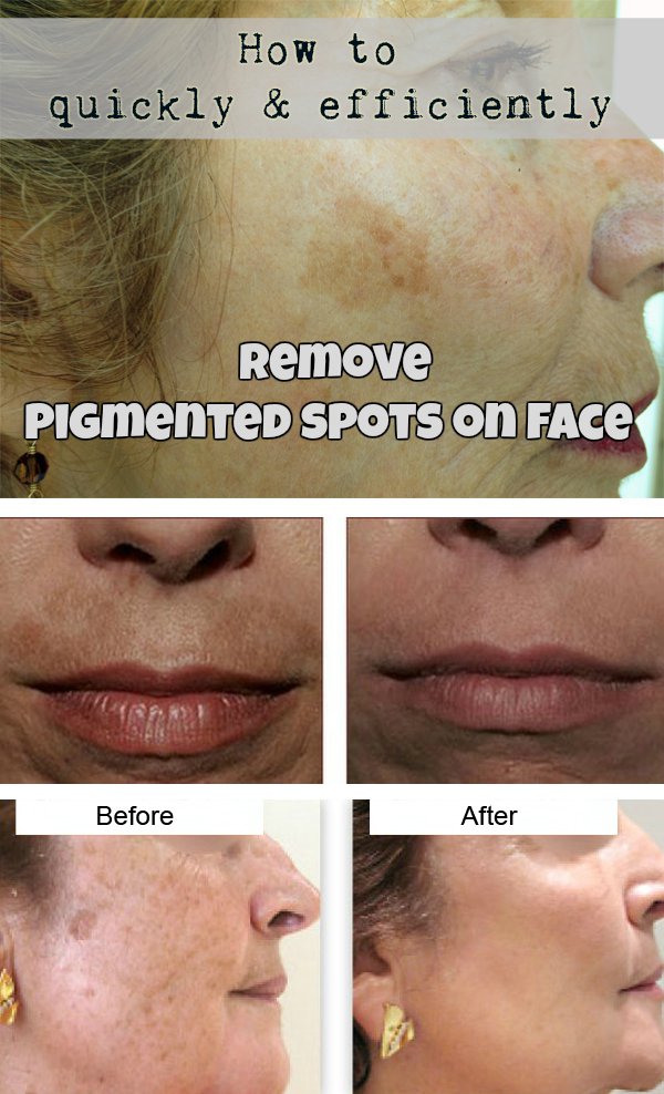 How To Quickly And Efficiently Remove Pigmented Spots On Face? 