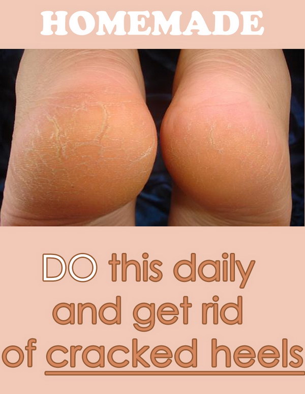 Homemade Remedy to Get Rid of Cracked Heels. 