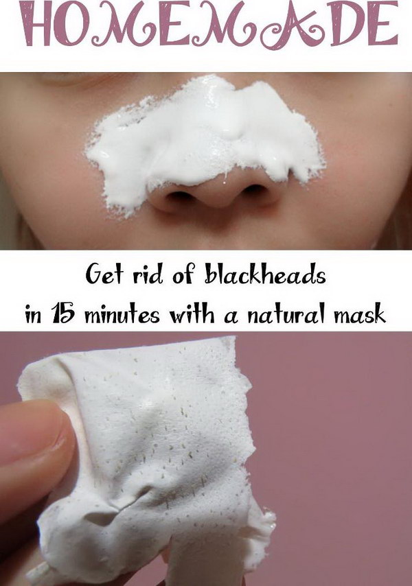 Get rid of Blackheads in 15 Minutes with a Natural Mask. 