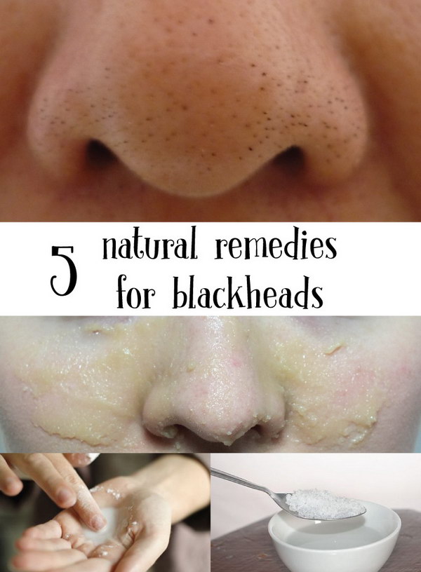 5 Natural Remedies for Blackheads. 