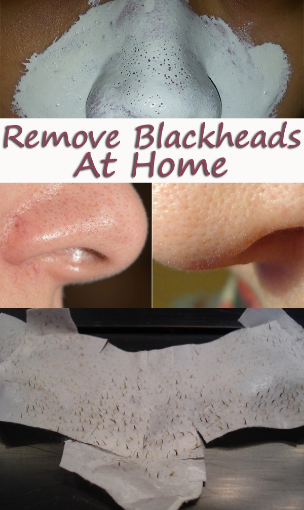Remove Blackheads with Egg Whites, Honey or Clay. 