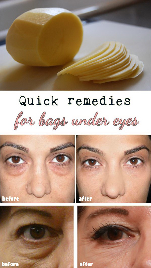 Use Potato Slices to Diminish Dark Circles And Eye Bags. 