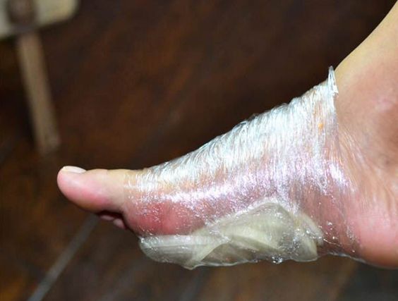 Attaching Sliced Onion With Plastic Wrap To Your Foot Will Help Cure Your Illnesses Overnight. 